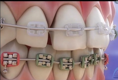 Teeth Alignment 1